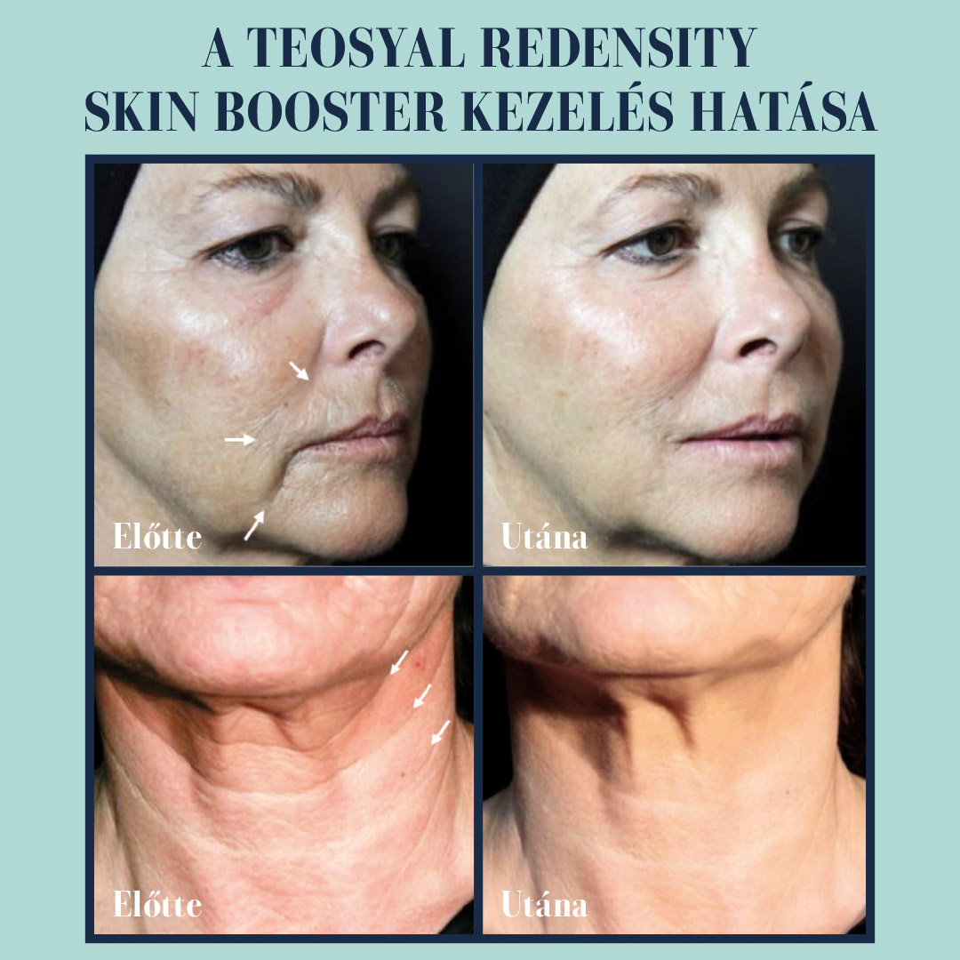 Skin Booster